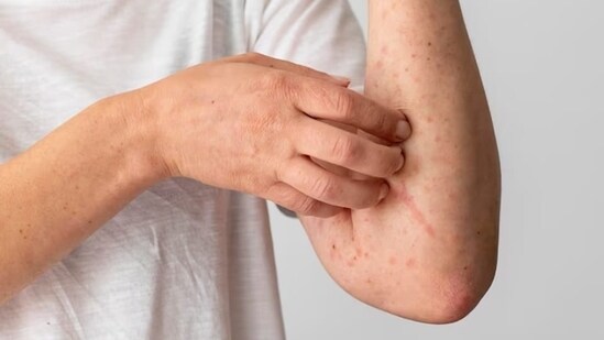 Use Mosquito Repellents: Apply mosquito repellents containing active ingredients like DEET, picaridin, or IR3535 when going outdoors, especially during peak mosquito activity hours.(Freepik)