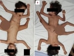 Indonesia: Three-year-old conjoined twins who underwent a corrective surgery. Indonesia: Three-year-old conjoined twins who underwent a corrective surgery.