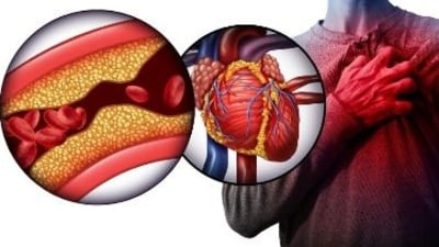 Hypertensive heart disease: Causes, symptoms, diagnosis, treatment (File Photo) Hypertensive heart disease: Causes, symptoms, diagnosis, treatment (File Photo)