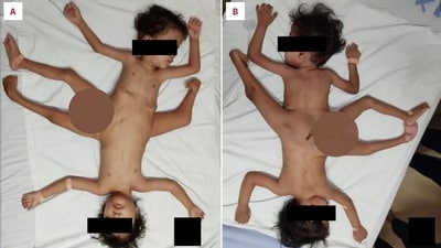 Indonesia: Three-year-old conjoined twins who underwent a corrective surgery. (American Journal of Case Reports) Indonesia: Three-year-old conjoined twins who underwent a corrective surgery. (American Journal of Case Reports)
