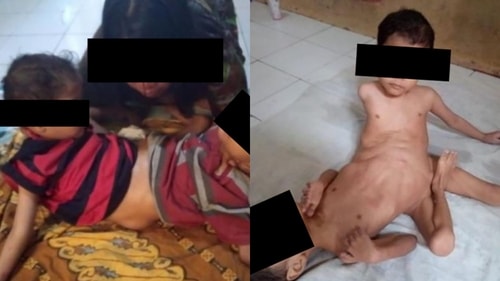 The picture shows the conjoined twins after successful limb-removal surgery. (American Journal of Case Reports) The picture shows the conjoined twins after successful limb-removal surgery. (American Journal of Case Reports)