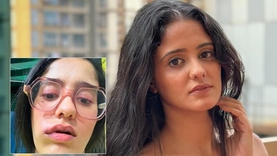 Ayesha Singh on her swollen face Ayesha Singh on her swollen face