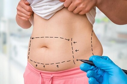 Tummy tuck may be a solution for appearance, but it does not address the underlying cause and condition,” cautions consultant gastroenterologist and hepatologist Dr Amol Dahale, of DPU Super Specialty Hospital, Pimpri, Pune (Shutterstock (for representation purposes only))