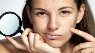 4. Resist the urge to pick or pop pimples! This can lead to scarring and worsen inflammation. (Shutterstock) 4. Resist the urge to pick or pop pimples! This can lead to scarring and worsen inflammation. (Shutterstock)