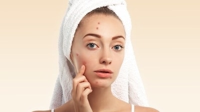 Looking for steps or seeking professional guidance to achieve a clearer, more even-toned complexion? In an interview with Zarafshan Shiraz of HT Lifestyle, D. Charu Sharma, Co-Founder and Director of Dermatology at Cureskin, recommended 4 tips to manage skin pigmentation and acne breakouts - (freepik) Looking for steps or seeking professional guidance to achieve a clearer, more even-toned complexion? In an interview with Zarafshan Shiraz of HT Lifestyle, D. Charu Sharma, Co-Founder and Director of Dermatology at Cureskin, recommended 4 tips to manage skin pigmentation and acne breakouts - (freepik)