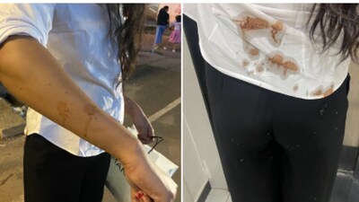 The X user shared photos of spit marks on her shirt and hand. (X/parishi_twts) The X user shared photos of spit marks on her shirt and hand. (X/parishi_twts)