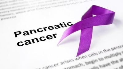 PDAC is one of the most aggressive and lethal cancers with an overall 5-year survival rate of 9%. (Shutterstock) PDAC is one of the most aggressive and lethal cancers with an overall 5-year survival rate of 9%. (Shutterstock)