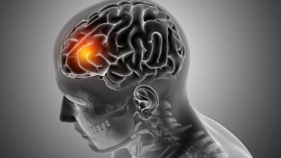World Brain Tumour Day 2024: Here are surprising reasons of brain tumour that people may overlook (Freepik) World Brain Tumour Day 2024: Here are surprising reasons of brain tumour that people may overlook (Freepik)