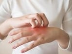 Sodium intake and eczema risk: Eating too much salt could raise chances of skin inflammation, says study 
