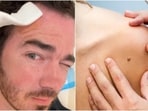 Kevin Jonas shared the video where he spoke of his surgery of getting a basal-cell carcinoma removed from a corner of his forehead. Kevin Jonas shared the video where he spoke of his surgery of getting a basal-cell carcinoma removed from a corner of his forehead.