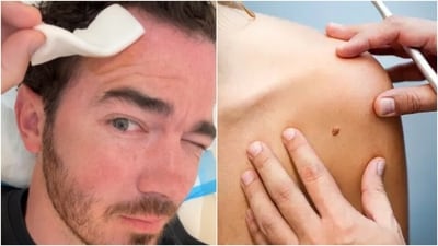 Kevin Jonas shared the video where he spoke of his surgery of getting a basal-cell carcinoma removed from a corner of his forehead. (Instagram, Unsplash) Kevin Jonas shared the video where he spoke of his surgery of getting a basal-cell carcinoma removed from a corner of his forehead. (Instagram, Unsplash)