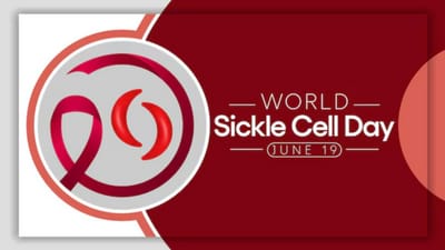 Every year on June 19, World Sickle Cell Day is observed. (Freepik) Every year on June 19, World Sickle Cell Day is observed. (Freepik)