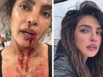 Priyanka Chopra shared an update about her injury on the sets her new movie - The Bluff.