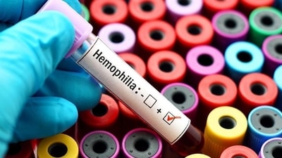Lesser known facts about Haemophilia: Experts' insights on origin of disease and its impact on males (HT File Photo) Lesser known facts about Haemophilia: Experts' insights on origin of disease and its impact on males (HT File Photo)