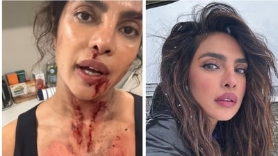 Priyanka Chopra shared an update about her injury on the sets her new movie - The Bluff. Priyanka Chopra shared an update about her injury on the sets her new movie - The Bluff.
