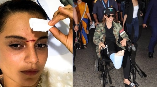 Kangana after getting hurt on the sets of Manikarnika: The Queen of Jhansi Kangana after getting hurt on the sets of Manikarnika: The Queen of Jhansi