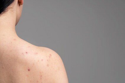 What causes body acne? (Freepik)