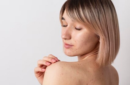 The market is booming with products that will help you deal with acne scars (Freepik)