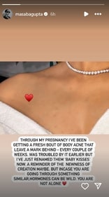 Masaba Gupta opens up about dealing with body acne during pregnancy (Instagram)
