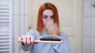 Hair loss: Hair loss in PCOS happens due to the accumulation of DHT – converted from Testosterone – around the hair follicles. (Pixabay) Hair loss: Hair loss in PCOS happens due to the accumulation of DHT – converted from Testosterone – around the hair follicles. (Pixabay)