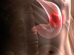Stomach cancer 101: Watch out for these key symptoms, risk factors and treatment options 