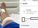 A 23-year-old Google techie shared this photo alleging she suffered these injuries after taking a Rapido bike in Bengaluru. 
