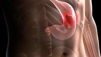 Stomach cancer 101: Watch out for these key symptoms, risk factors and treatment options (Photo by Twitter/WebMD) Stomach cancer 101: Watch out for these key symptoms, risk factors and treatment options (Photo by Twitter/WebMD)