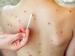 MSF doctors fear the appearance of other skin conditions such as leishmaniasis, which can be fatal in its most virulent form. MSF doctors fear the appearance of other skin conditions such as leishmaniasis, which can be fatal in its most virulent form.
