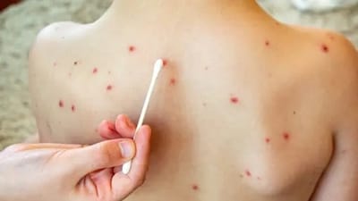 MSF doctors fear the appearance of other skin conditions such as leishmaniasis, which can be fatal in its most virulent form. (Unsplash) MSF doctors fear the appearance of other skin conditions such as leishmaniasis, which can be fatal in its most virulent form. (Unsplash)