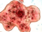 Medical experts said the infection occurs when free-living, non-parasitic amoebae bacteria enter the body through the nose from contaminated water.. 