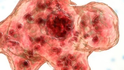 Medical experts said the infection occurs when free-living, non-parasitic amoebae bacteria enter the body through the nose from contaminated water.. (source: CDC)