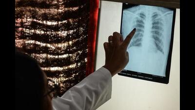 A doctor checks the chest X-ray of a patient in the tuberculosis (TB) department of the government-run Osmania General Hospital in Hyderabad on October 30, 2019. (Photo by NOAH SEELAM / AFP) (AFP) A doctor checks the chest X-ray of a patient in the tuberculosis (TB) department of the government-run Osmania General Hospital in Hyderabad on October 30, 2019. (Photo by NOAH SEELAM / AFP) (AFP)