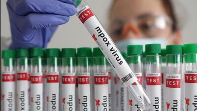 Laboratory confirmation of Mpox is carried out by testing skin lesion material by polymerase chain reactions. (REPRESENTATIVE PHOTO)