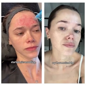 Valeria Lipovetsky recently tried out the microneedling procedure for the first time (Photo: Instagram) Valeria Lipovetsky recently tried out the microneedling procedure for the first time (Photo: Instagram)