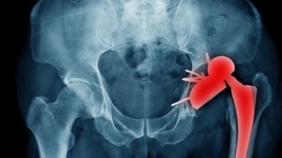Study states that patients with hip replacement have a five-fold greater risk of death within a ten-year period. (Shutterstock) Study states that patients with hip replacement have a five-fold greater risk of death within a ten-year period. (Shutterstock)