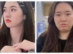Overwork obesity involves rapid weight gain due to stress. Before and After pics of the Chinese woman who suffered from overwork obesity. Overwork obesity involves rapid weight gain due to stress. Before and After pics of the Chinese woman who suffered from overwork obesity.