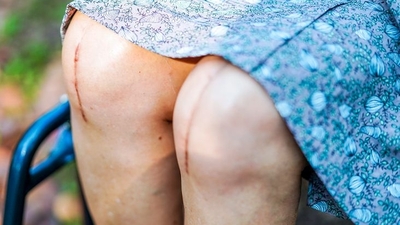 Robotic vs traditional knee replacement: Which is right for your parents? (File Photo)