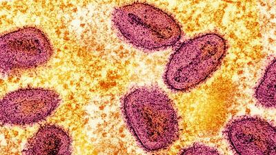 On August 14, the World Health Organisation (WHO) declared mpox a Public Health Emergency of International Concern (PHEIC) for the second time in the past two years. (via REUTERS) On August 14, the World Health Organisation (WHO) declared mpox a Public Health Emergency of International Concern (PHEIC) for the second time in the past two years. (via REUTERS)