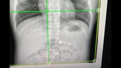 Teleradiology includes transmission of radiological images, such as X-rays, CT scan and MRI from one location to another for an expert opinion. Teleradiology includes transmission of radiological images, such as X-rays, CT scan and MRI from one location to another for an expert opinion.