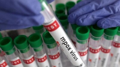 India reports first case of Mpox Clade 1 strain (REPRESENTATIVE PHOTO) India reports first case of Mpox Clade 1 strain (REPRESENTATIVE PHOTO)