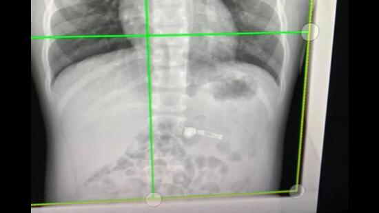 Teleradiology includes transmission of radiological images, such as X-rays, CT scan and MRI from one location to another for an expert opinion.