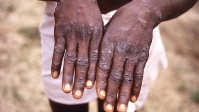 Mpox deadly virus is back and worse than ever: Urgent prevention tips for families amid India's latest health crisis (AP/picture alliance) Mpox deadly virus is back and worse than ever: Urgent prevention tips for families amid India's latest health crisis (AP/picture alliance)