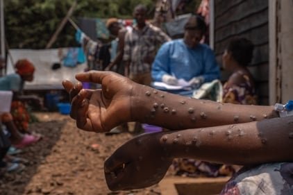 Mpox rashes (Photo by Glody MURHABAZI / AFP) Mpox rashes (Photo by Glody MURHABAZI / AFP)