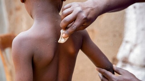 India reported its first case of mpox. (HT_PRINT) India reported its first case of mpox. (HT_PRINT)