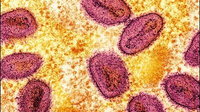 An undated colorised transmission electron micrograph of mpox virus particles (pink) found within an infected cell (yellow), cultured in a laboratory. (Reuters Photo) An undated colorised transmission electron micrograph of mpox virus particles (pink) found within an infected cell (yellow), cultured in a laboratory. (Reuters Photo)