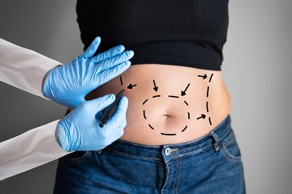 There are two types of liposuction procedures — of less than five litres and more than five litres — and the former is considered safer. (Photo: Shutterstock) There are two types of liposuction procedures — of less than five litres and more than five litres — and the former is considered safer. (Photo: Shutterstock)