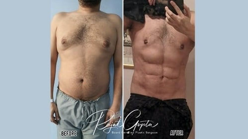 Gynecomastia correction along with high definition liposuction of abdomen done in this patient by Dr Rajat Gupta (File Photo) Gynecomastia correction along with high definition liposuction of abdomen done in this patient by Dr Rajat Gupta (File Photo)