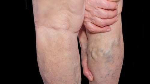 A study found people with varicose veins were at a five times increased risk of developing a deep venous thrombosis (DVT) -- a clot in the legs which can lead to amputation or even death (Shutterstock) A study found people with varicose veins were at a five times increased risk of developing a deep venous thrombosis (DVT) -- a clot in the legs which can lead to amputation or even death (Shutterstock)