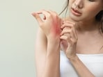It is not just about itchy skin: Know surprising truth about Atopic Dermatitis as Eczema is on the rise in India 