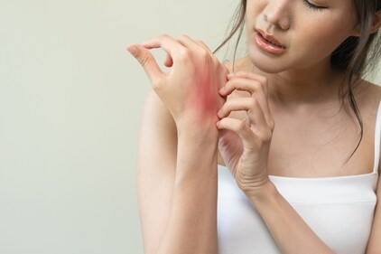 People with dry skin are likely to be more vulnerable to eczema. ( Shutterstock) People with dry skin are likely to be more vulnerable to eczema. ( Shutterstock)